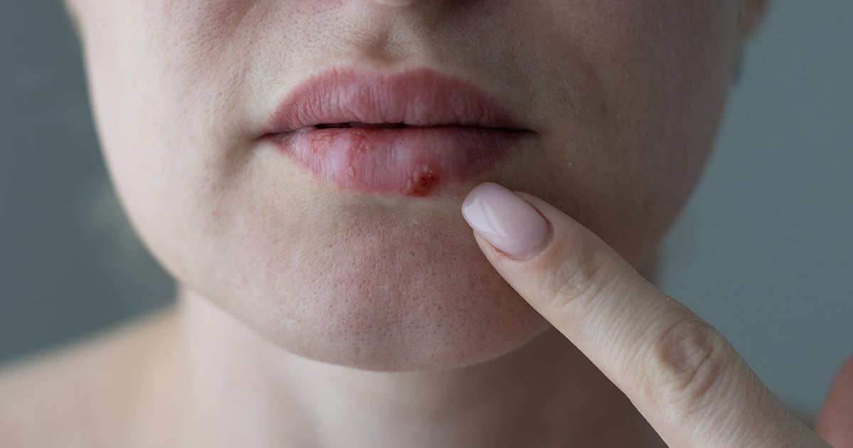 La FDA aprobó un antiviral oral inédito en casi treinta años para tratar el herpes resistente en pacientes inmunocomprometidos