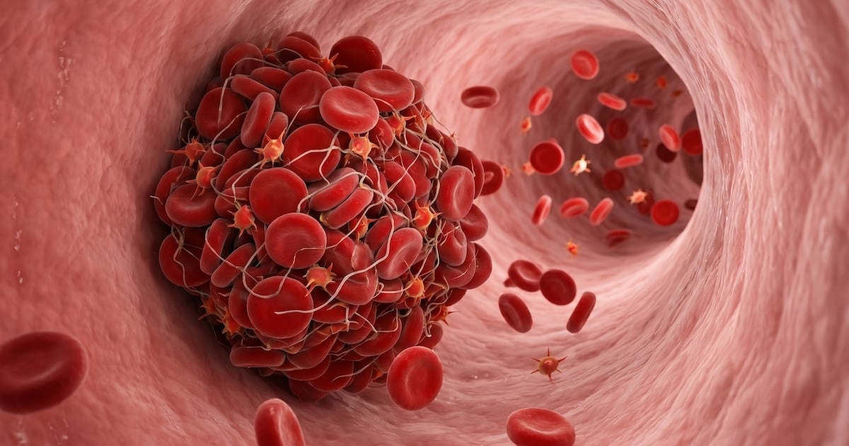 Trombosis venosa: las cuatro señales físicas que el cardiólogo Francesco Lo Monaco recomienda no pasar por alto y los momentos de la vida en los que el riesgo se eleva