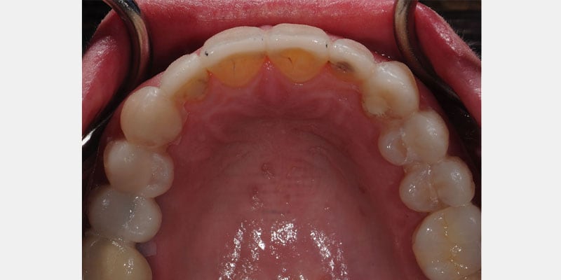 Carillas dentales: señales de filtración y riesgos de postergar su reparación